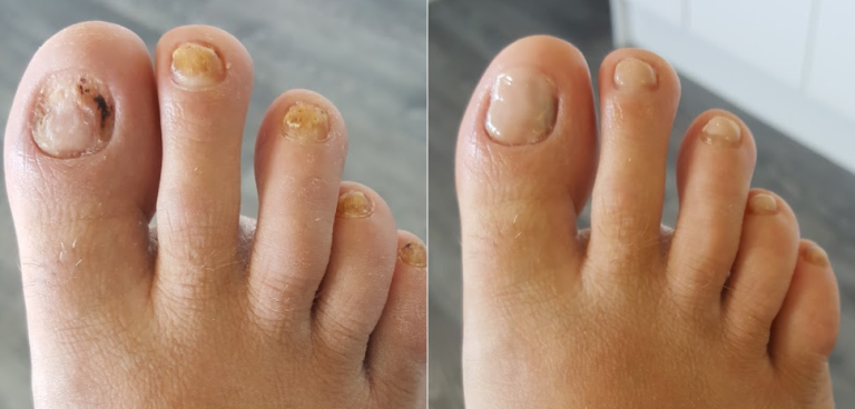 Treatments Nail Reconstruction SoleAmbition Treatments Nail Reconstruction SoleAmbition