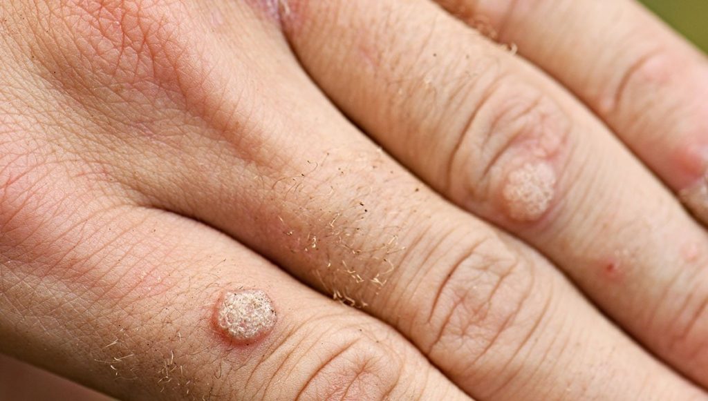 Genital Warts Come Back After 10 Years